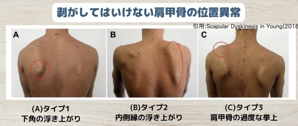 剥がしてはいけない肩甲骨の位置異常