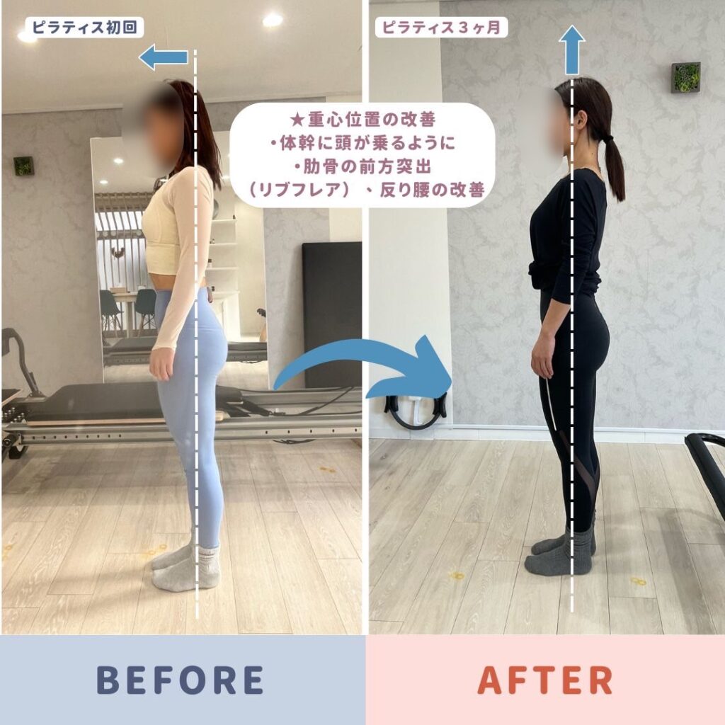反り腰が改善した女性