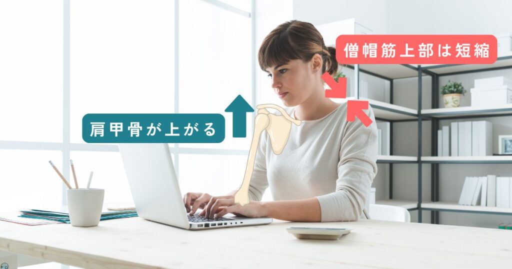 僧帽筋上部線維の短縮