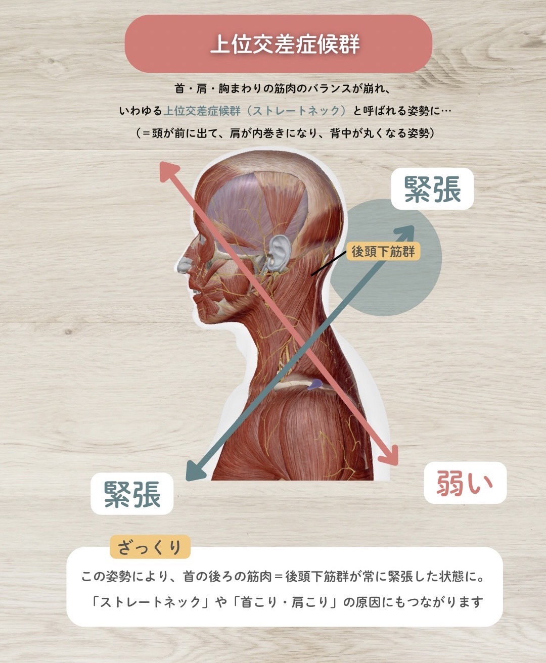上位交差症候群