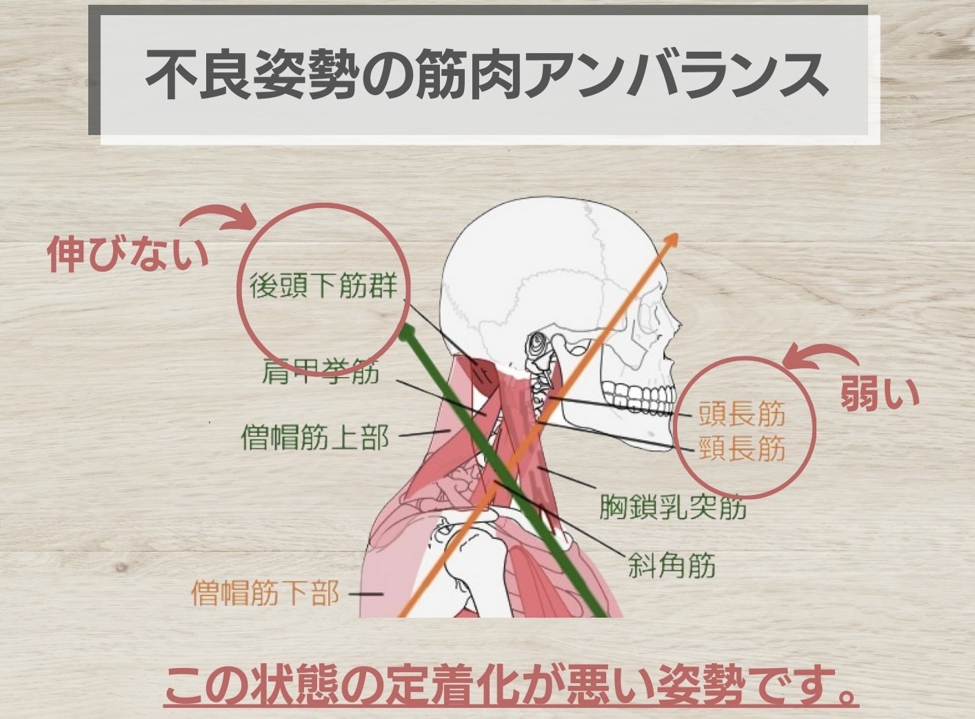 上位交差症候群
