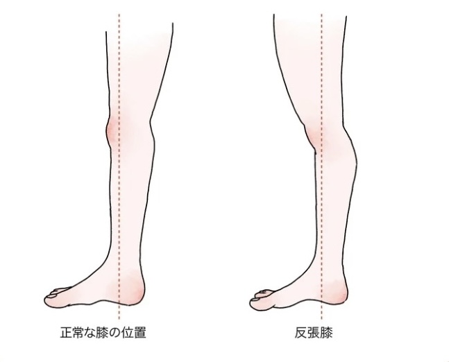 反張膝(はんちょうひざ)
