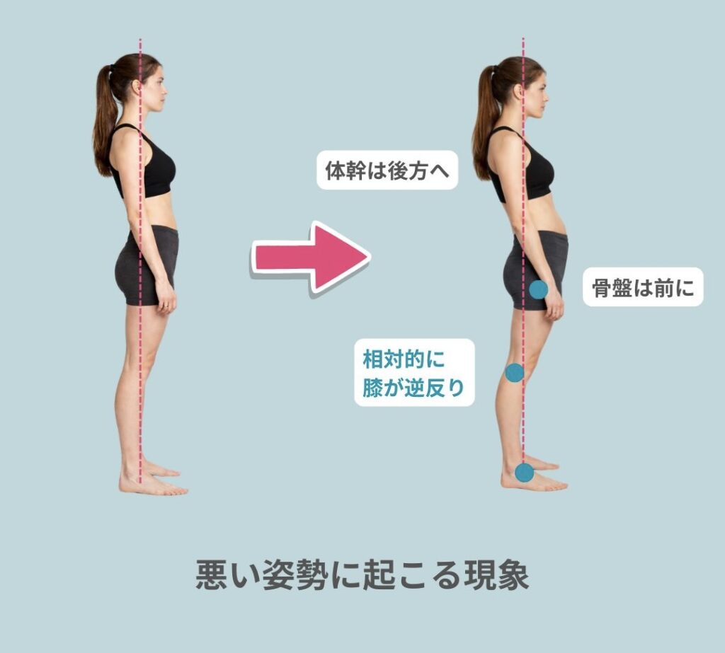 反張膝の原因は？